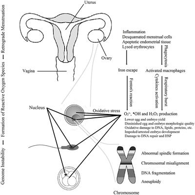 Endometriosis Is a Cause of Infertility. Does Reactive Oxygen Damage to Gametes and Embryos Play a Key Role in the Pathogenesis of Infertility Caused by Endometriosis?